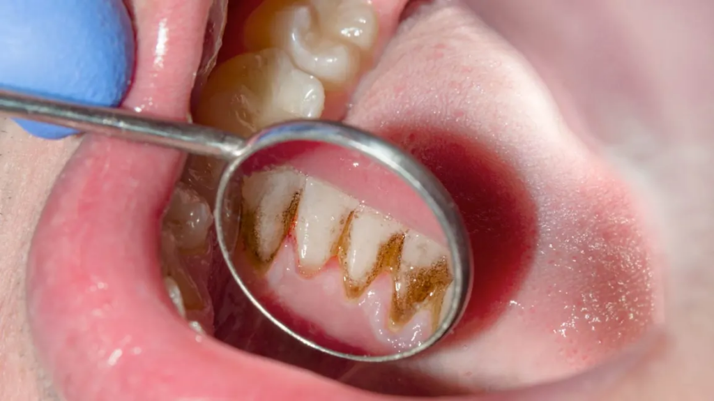 Gingivitis Gum Disease