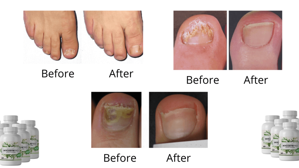 Mycosyn Pro before and after