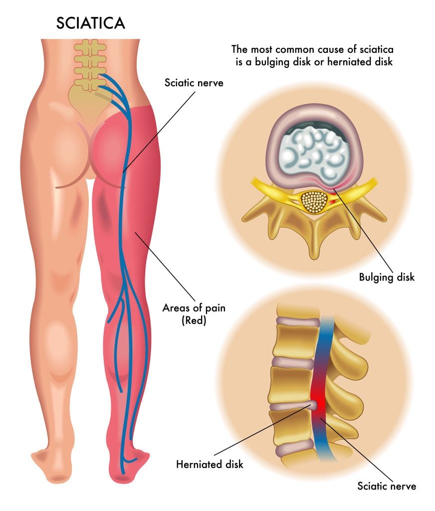 Cause of sciatica