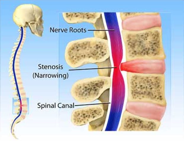 Spinal Issues