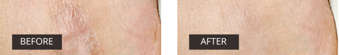 Dermefface FX7 before and after