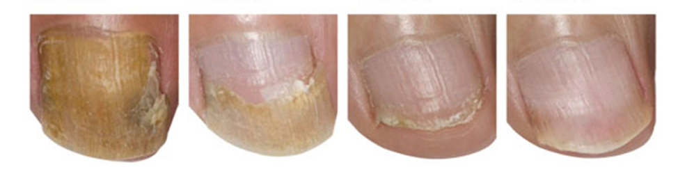 toenail fungus pictures