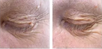 Skincell Pro before and after