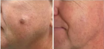 Skincell Pro Before and after