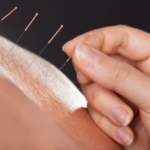 Does Acupuncture Help Neuropathy